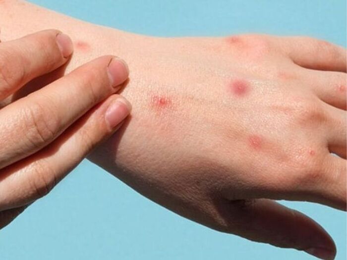 Vết cắn của bọ chét